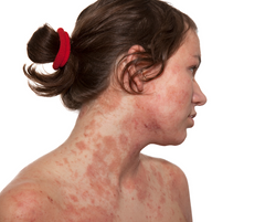 Tallow for Eczema: A Natural Remedy That Works