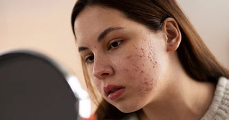 Tallow for Acne: The Counterintuitive Truth