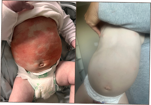 Helped my little boys eczema