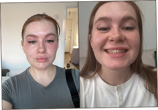 I’d had a very itchy rash on my neck