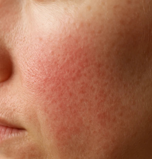 Sensitive skin